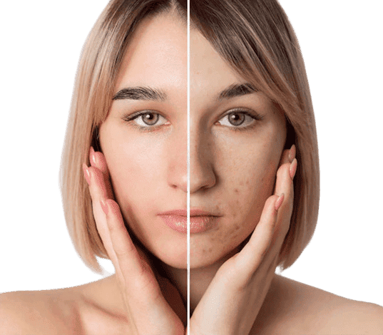 Bisnis Raletsia Atasi MAsalah Kulit